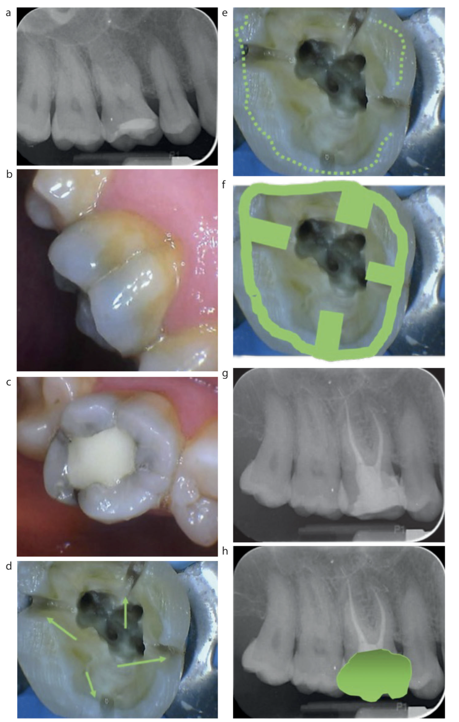 Bruxism Là Gì? Cách Chẩn Đoán Và Điều Trị Răng Nứt Do Nghiến Răng Hiệu Quả
